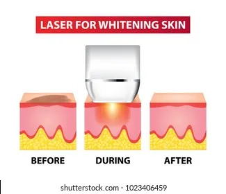 32120 laser skin whitening procedure