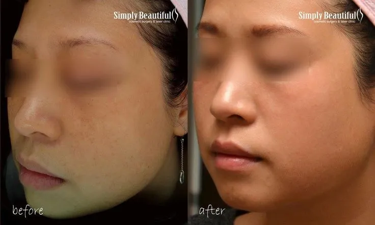 32120 laser skin whitening recovery