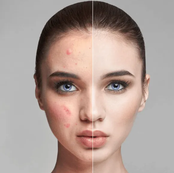 32120 laser treatment process