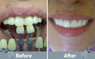 32123 in office teeth whitening