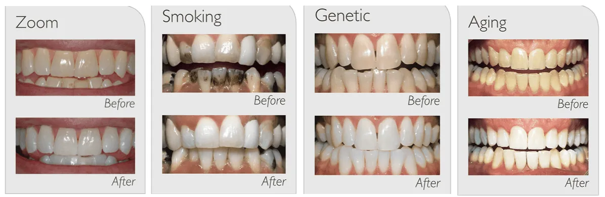 32123 teeth whitening process