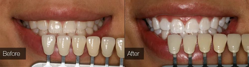 32128 teeth whitening process