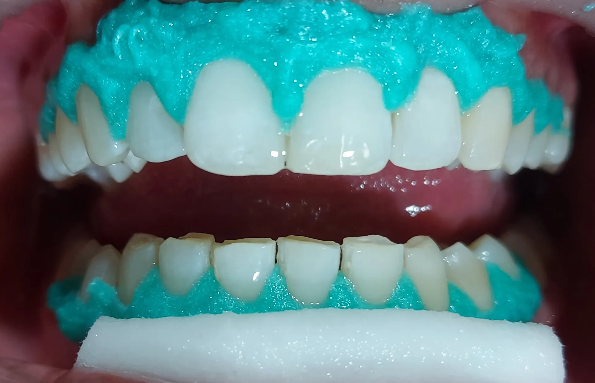 32131 at home teeth whitening