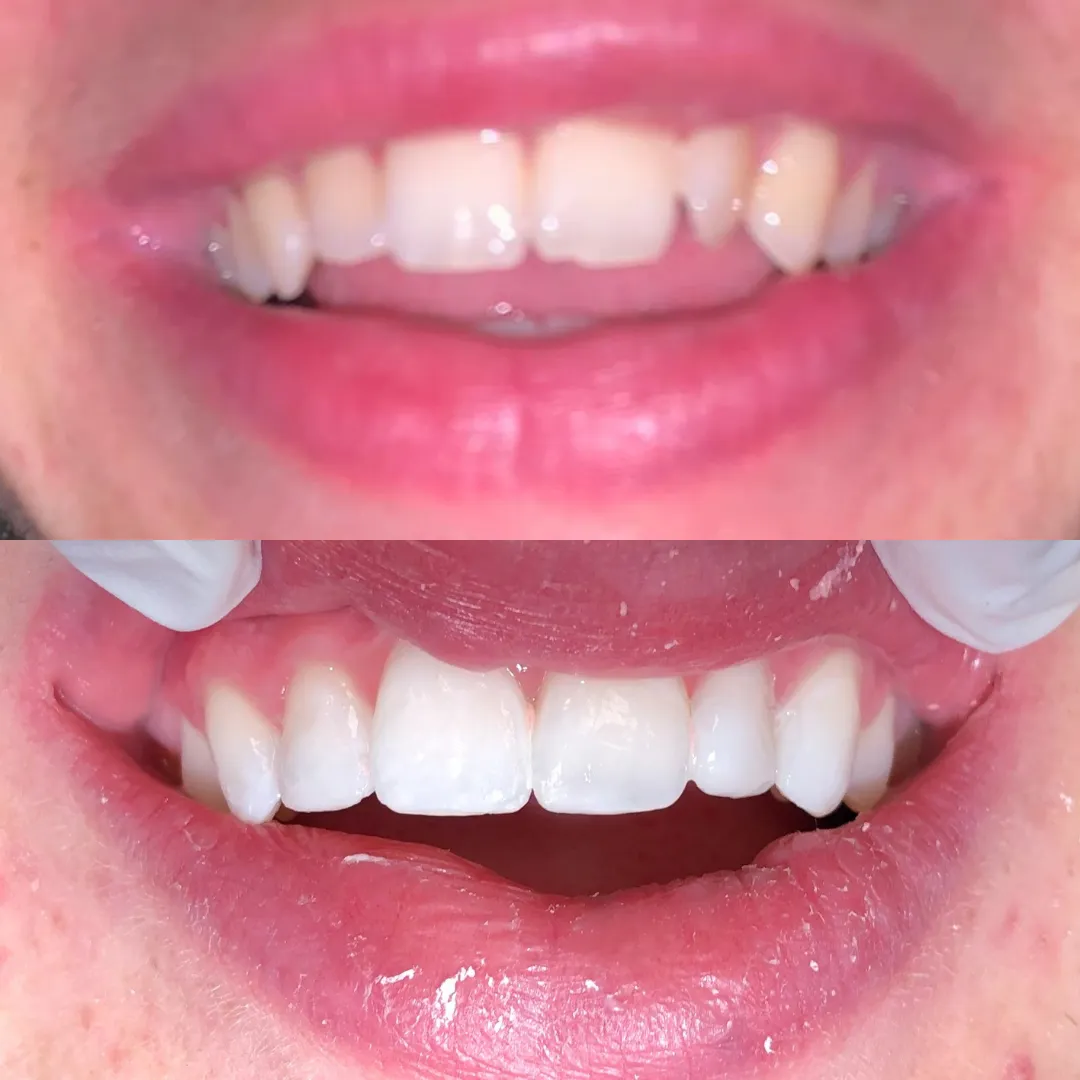 32138 professional teeth whitening